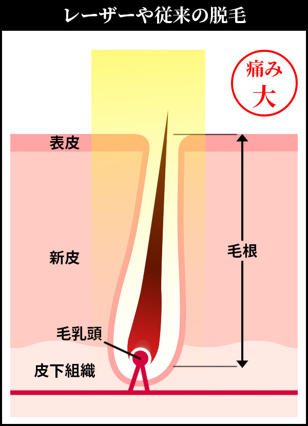 レーザーや従来の脱毛