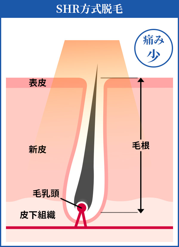 SHR方式脱毛